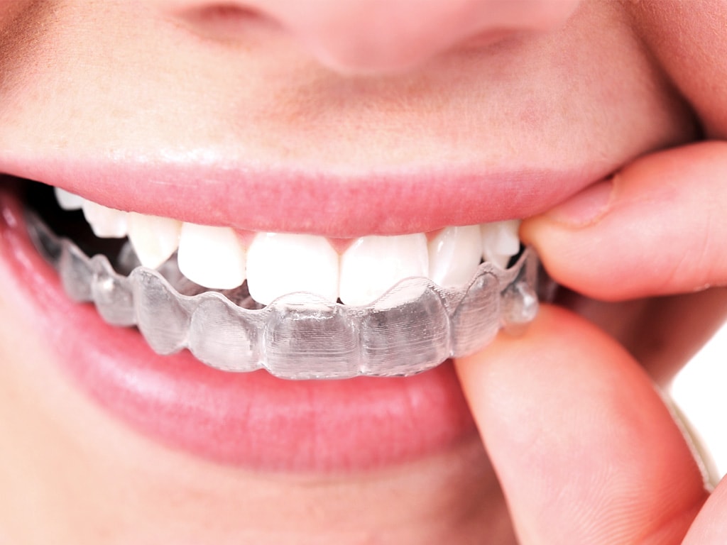 What's the difference between Invisalign and Metal Braces? - Bluebird  Family Dentistry & Orthodontics