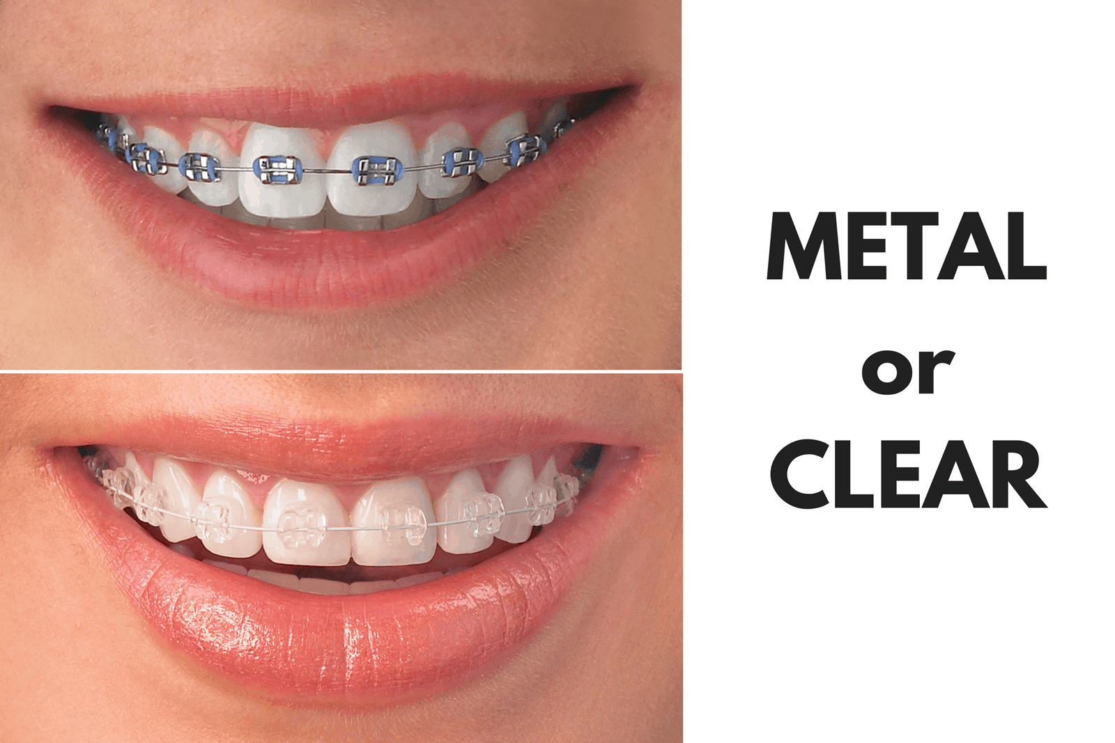 Ask Your Northglenn Dentist: Should I Get Metal or Clear Braces?